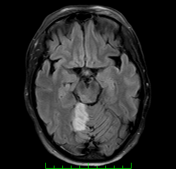Brain MRI scan showing acute Ischemic stroke involving the territory of the right superior cerebellar artery (SCA)