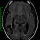 A mri of the brain with green lines indicating where to place it.