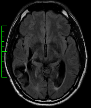 MRI showing injury to the right posterior temporal and parietal lobes due to remote right hemispheric stroke (one year ago)