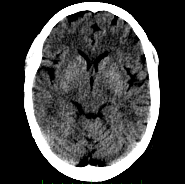 Subtle Ischemic Stroke Visible In the Right Superior Cerebellar Artery Territory