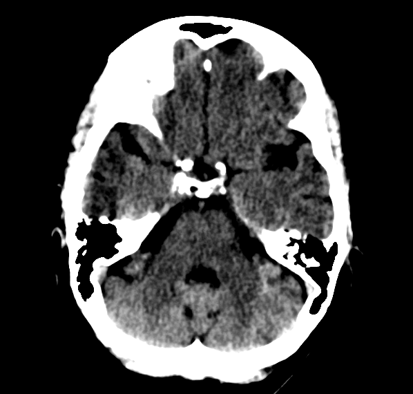 Brain CT scan showing compression of the lateral recess of the 4th ventricle on the right